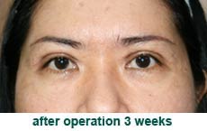 plastic-surgery-blepharoplasty